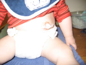 Henry's g-tube with cloth diapers